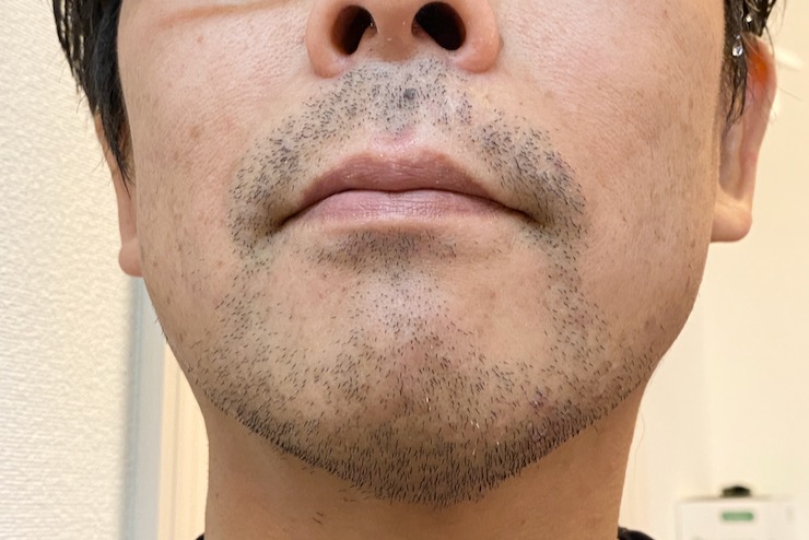 トリア脱毛器でヒゲ脱毛 使用感 痛み 脱毛効果を体験レビュー 毎週更新 Stationery Life