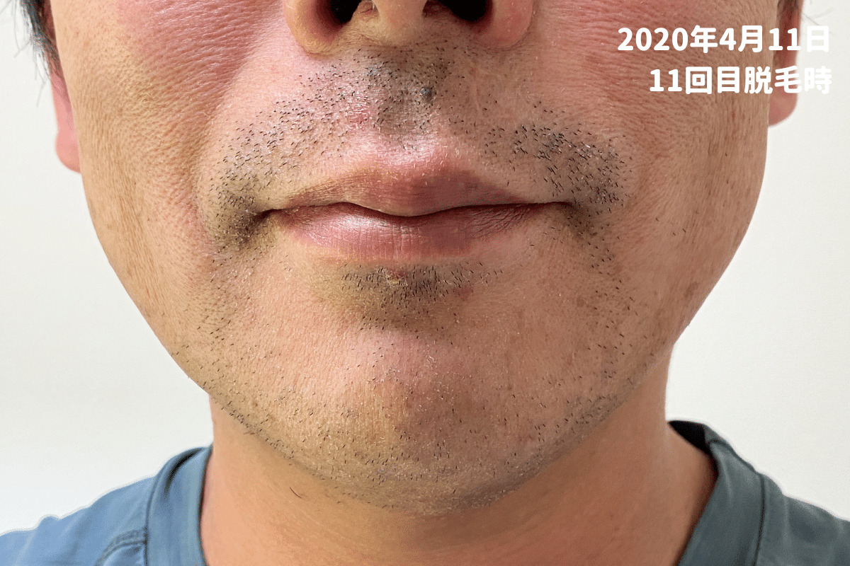 トリアで髭脱毛 痛みや効果 経過をレビュー 3カ月間でどれだけ髭は減るのか体験談 Stationery Life
